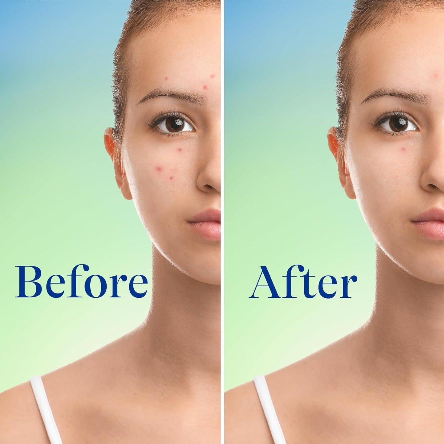 Differin Acne Face Wash with 10% Benzoyl Peroxide, 5 oz.