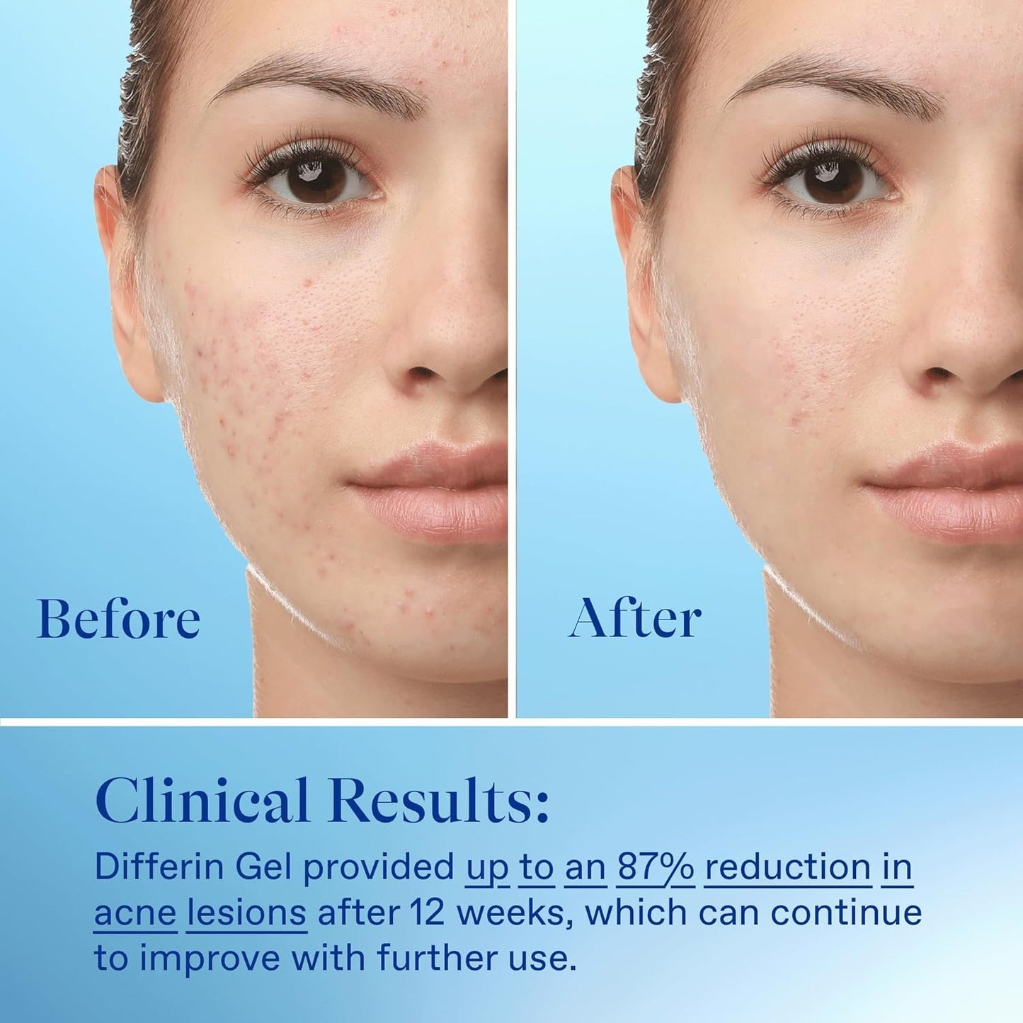 Differin Acne Treatment Gel, 45g Tube, Pack of 2 (Packaging May Vary)