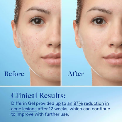 Differin Acne Treatment Gel, 45g Tube, Pack of 2 (Packaging May Vary)
