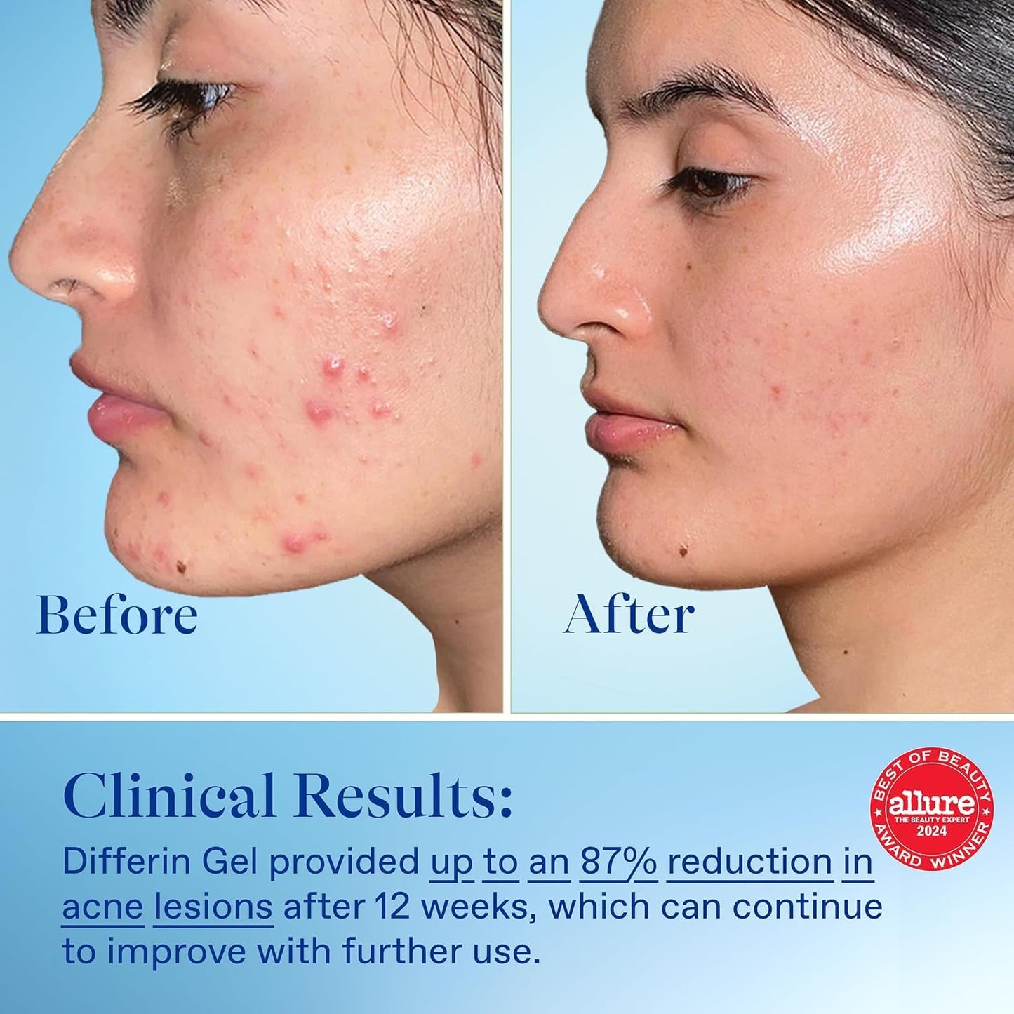 Differin Acne Treatment Gel, 45g Tube, Pack of 2 (Packaging May Vary)